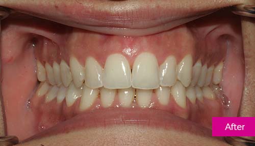 Invisalign and Teeth Whitening after 1