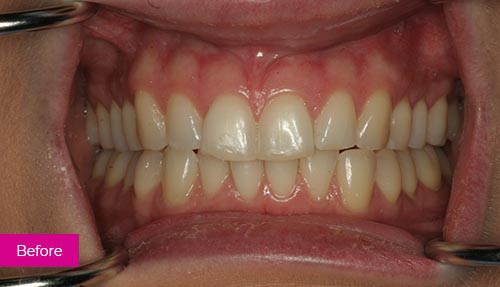 Teeth Whitening and Bonding Before 1
