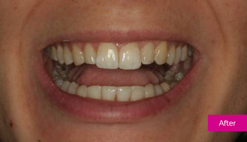 invisalign after 1