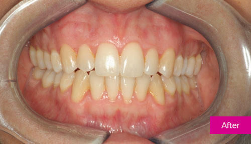 Invisalign after 3