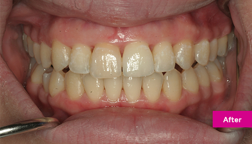 Invisalign Contouring After 1