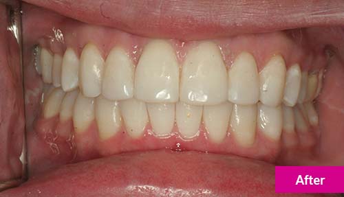 Invisalign Lite, Teeth Whitening and Dental Bonding After 2