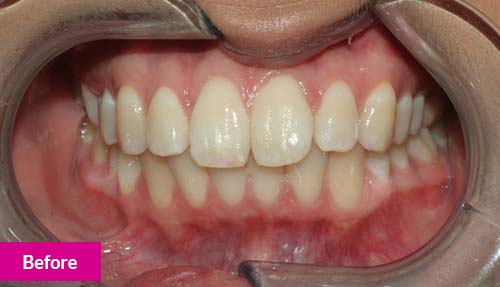 Invisalign Lite, Teeth Whitening and Dental Bonding Before 2