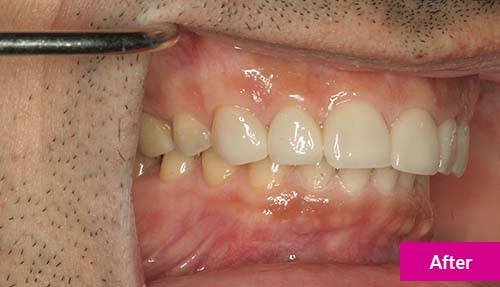 Teeth Reconstruction After 2