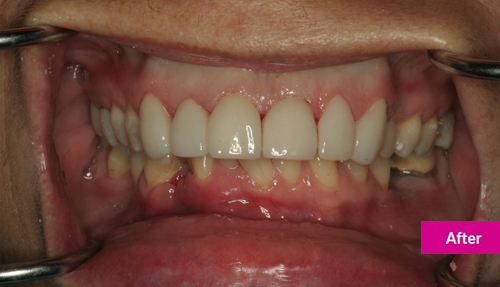 Upper veneers to better shape and alignment of teeth After